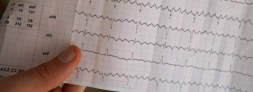 Echocardiogram lines